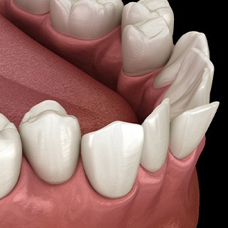 Illustration of crooked teeth