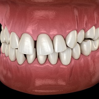 Illustration of gapped teeth