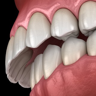Illustration of an overbite
