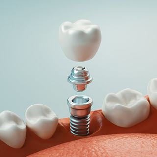 single dental implant being placed in the lower jaw