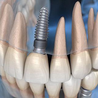 X ray of a patient with a dental implant in their upper arch