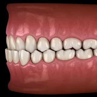 Illustration of an underbite