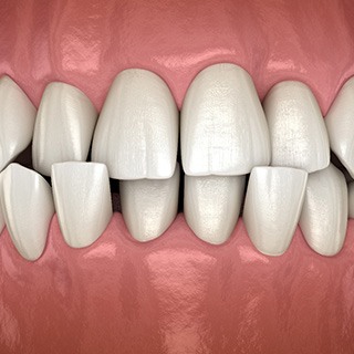 Illustration of a crossbite