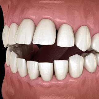 Illustration of an open bite