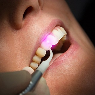Close up of soft tissue laser being used on a dental patient