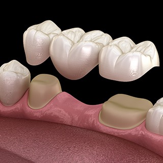 A traditional dental bridge in Pembroke Pines