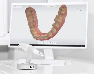 Digital dental impressions on computer