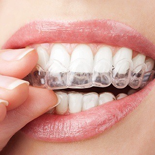 Close up of a person placing a clear aligner over their teeth