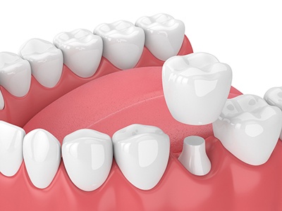 Model of dental crowns for treating damaged teeth.