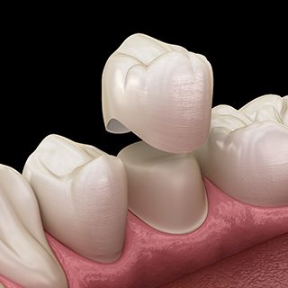 Illustrated dental crown being fitted onto a tooth