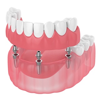 Digital image of implant dentures in Pembroke Pines