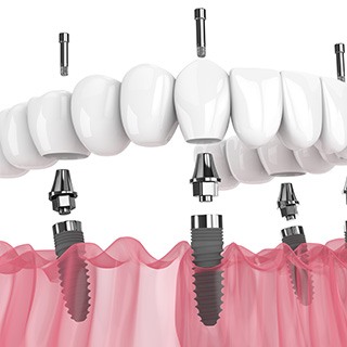 Digital image of All-on-4 denture