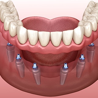 Model of dental implants supporting dentures