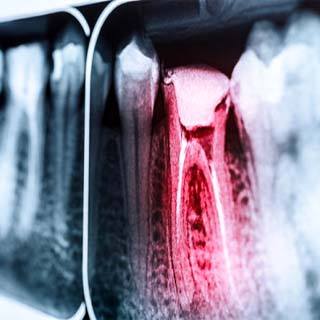 X ray of a toothache in Pembroke Pines