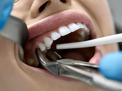 Close up of a dental patient receiving tooth extractions in Pembroke Pines