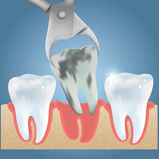illustration of tooth being extracted with a clasp