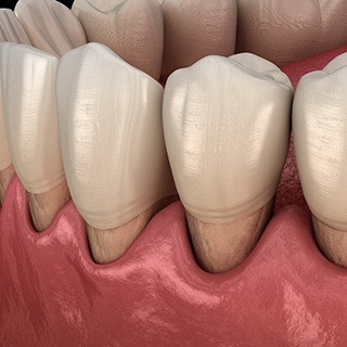 computer illustration of gums receding