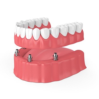 An implant-retained denture.