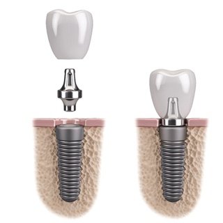 Diagram of dental implants in Pembroke Pines