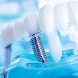 A model of an integrated dental implant in Pembroke Pines