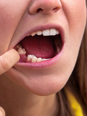 Woman pulling back her lip to show missing tooth