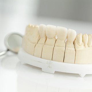 Model of the mouth with fixed bridge restoration
