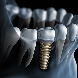 Illustrated dental implant with dental crown in the lower jaw