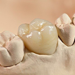 Model of the mouth with a dental crown covering one tooth