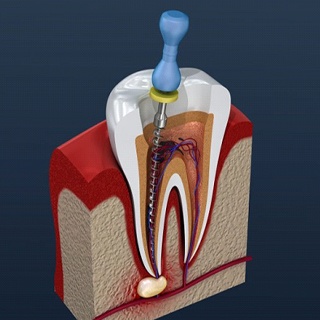 diagram of root canal therapy