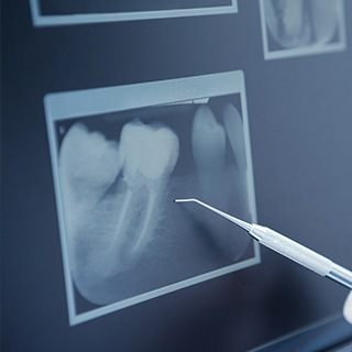 Digital dental x ray of teeth