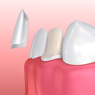 computer illustration of veneers being placed over teeth