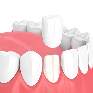 Illustration of a veneer being placed over a tooth