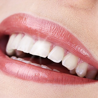 Close up of sparkling smile with veneers
