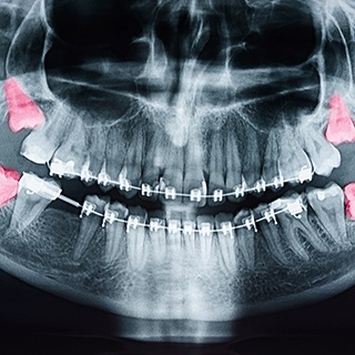 X ray showing four impacted wisdom teeth