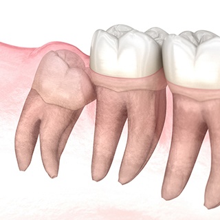 Impacted wisdom tooth crowding nearby molars