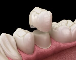 Close-up of animated dental crown fitting over tooth. 